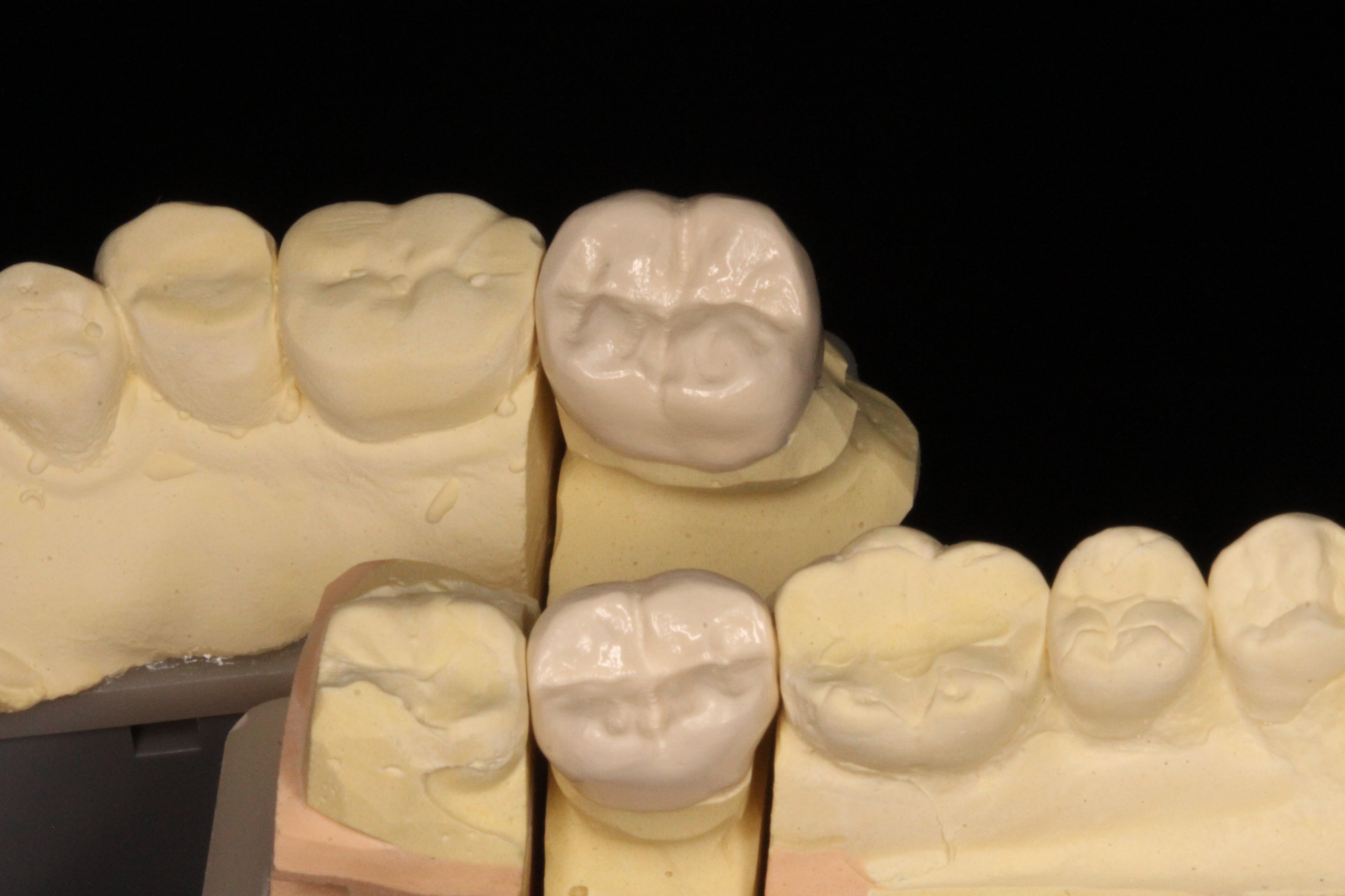Dentoryで製作したPEEK冠